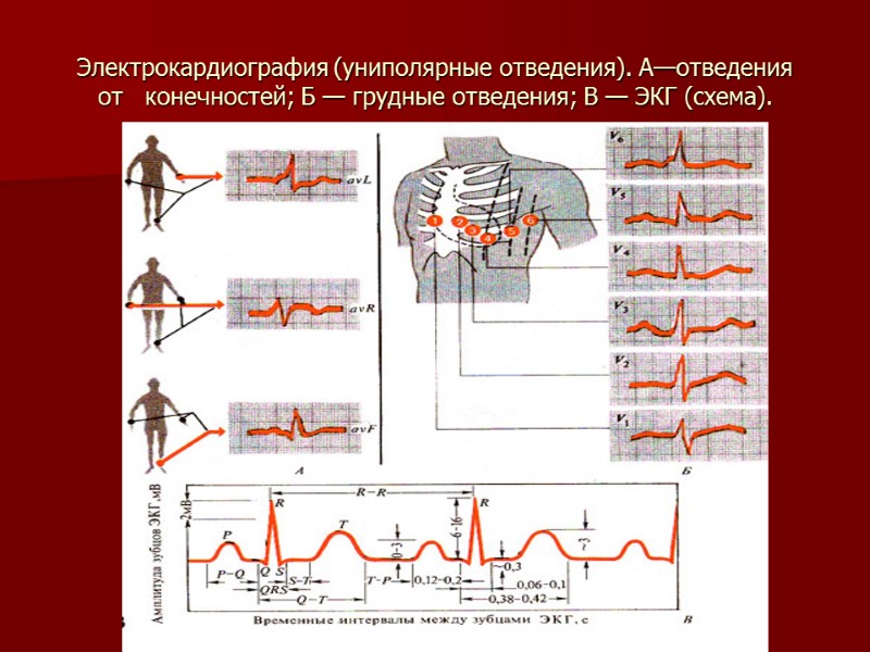 Электрокардиография (униполярные отведения). А—отведения от   конечностей; Б — грудные отведения; В —